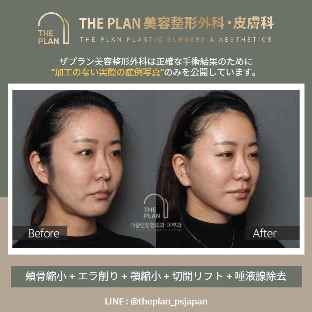 韓国切開リフト