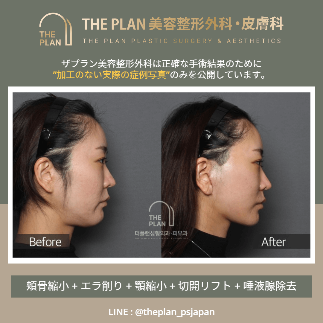 韓国切開リフト