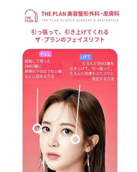 韓国切開リフト