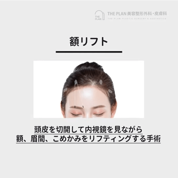 韓国額リフト