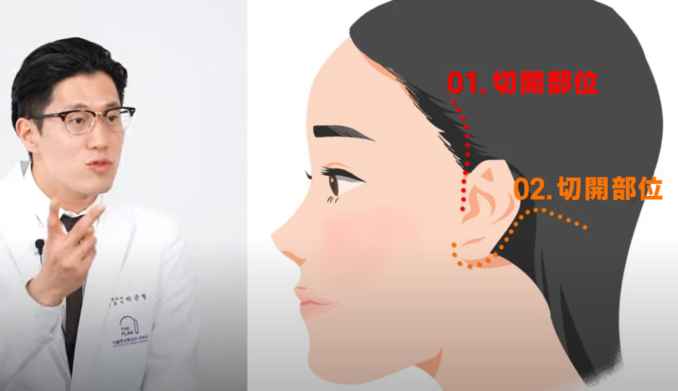 韓国 ミニ切開リフト手術で時間と傷を巻き戻します