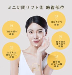 ミニ切開リフト術部位