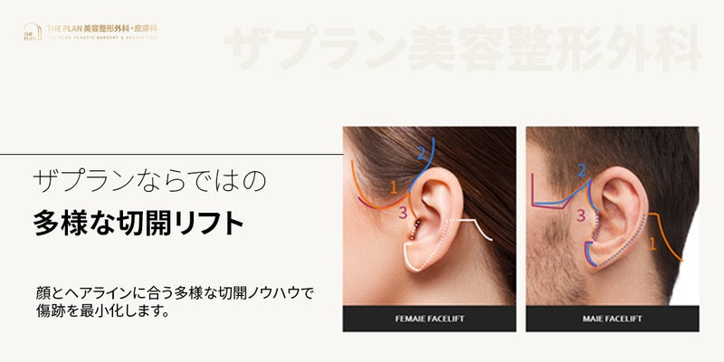 ザプラん美容外科の切開リフト手術ノーハウ