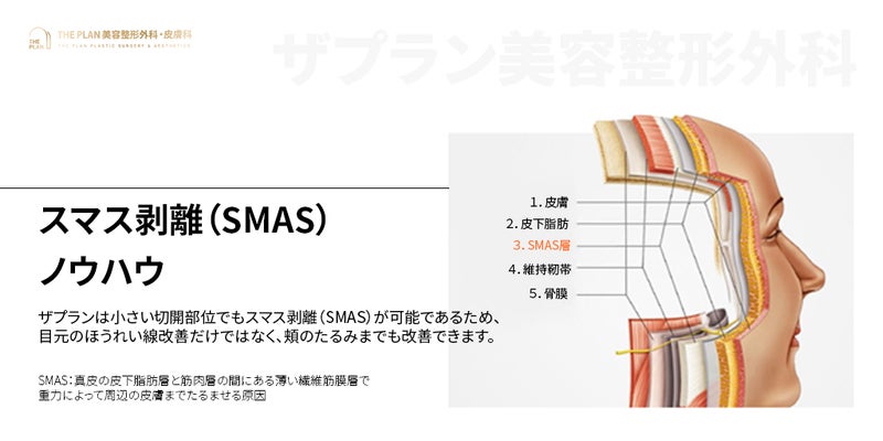 ザプラン美容外科のスマス剥離(SMAS)ノウハウとスマス剥離の説明