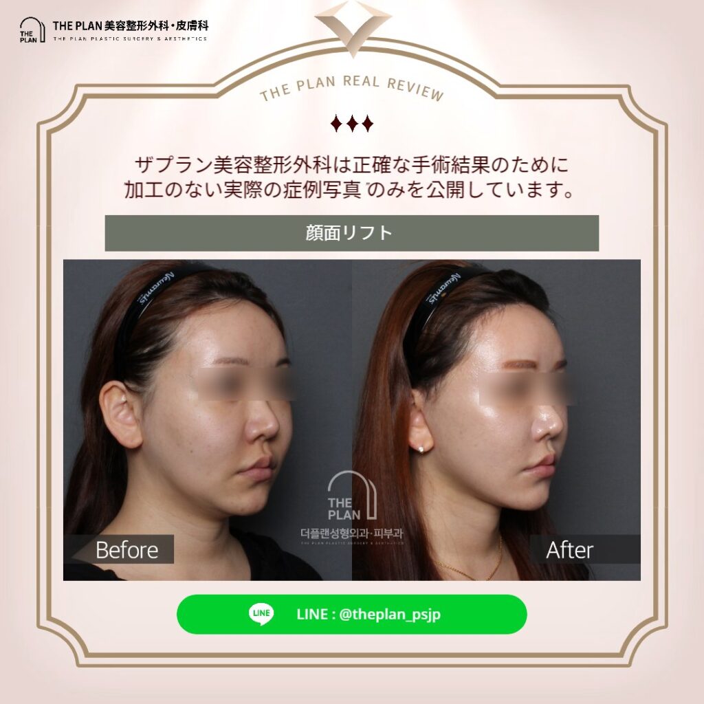 ザプラン美容整形外科の最新切開リフト手術を受けたモデル