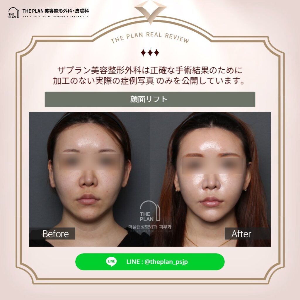 ザプラン美容整形外科の最新切開リフト手術を受けたモデル