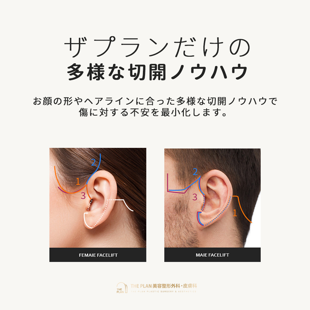 ザ·プランの性別によって変わる切開リフト方法