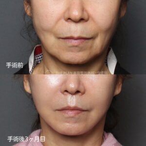 ザプランで切開リフトと人中縮小を一気に！