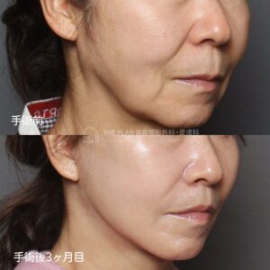 ザプランで切開リフトと人中縮小の前後写真