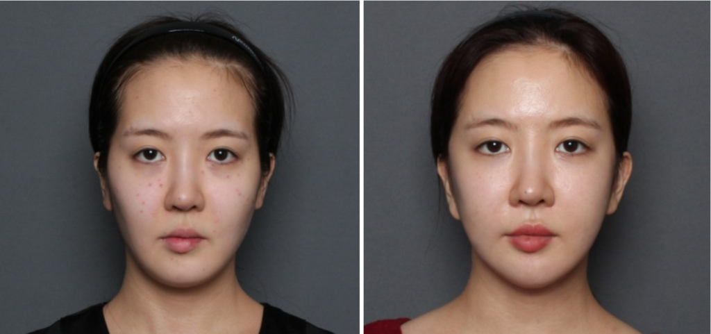 THEPLAN美容整形外科・皮膚科にて切開リフトを行った20代から30代の女性の正面の写真