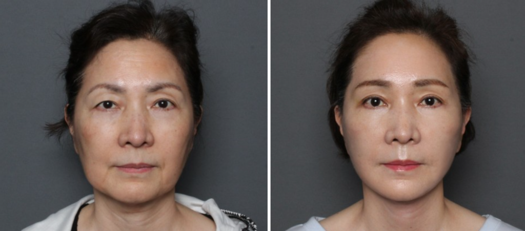 THEPLAN美容整形外科・皮膚科にて切開リフトを行った60代から70代の女性の正面の写真