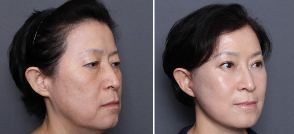 THEPLAN美容整形外科・皮膚科にて切開リフトを行った60代から70代の女性の横向きの写真