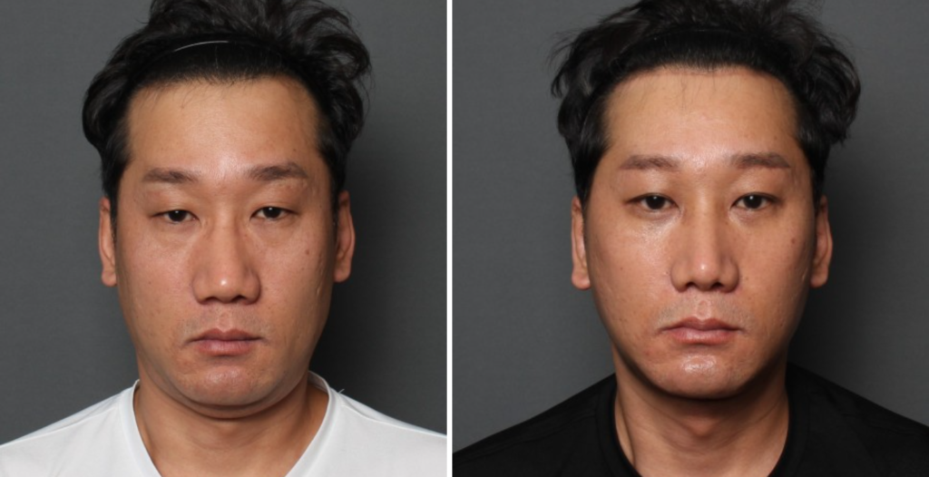 THE PLAN美容整形外科で切開リフトを受けた40代男性の手術前と手術後の写真