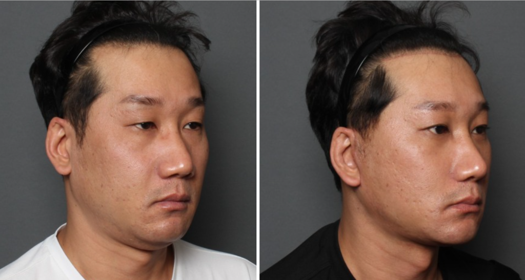 THE PLAN美容整形外科で切開リフトを受けた40代男性の手術前と手術後の写真