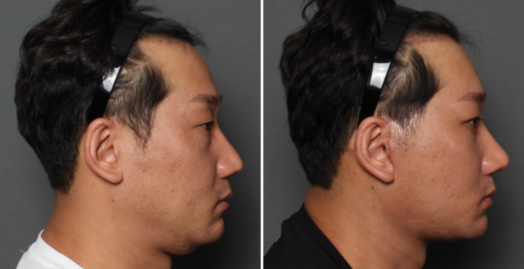 THE PLAN美容整形外科で切開リフトを受けた40代男性の手術前と手術後の写真
