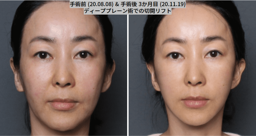 THE PLAN美容整形で切開ロフトを受けた女性の写真