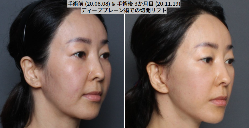 THE PLAN美容整形で切開ロフトを受けた女性の写真