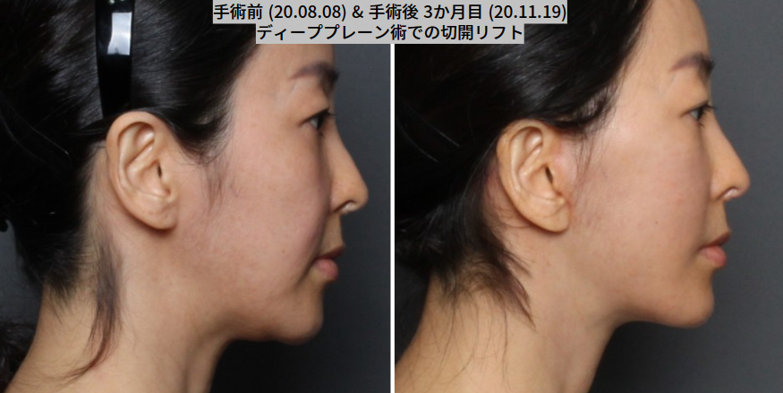 THE PLAN美容整形で切開ロフトを受けた女性の写真