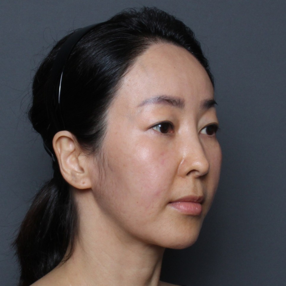 THE PLAN美容整形で切開ロフトを受けた女性の写真