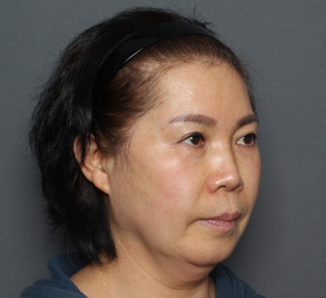 THEPLAN美容整形外科で切開リフトを受けた62 歳女性の横向きの写真