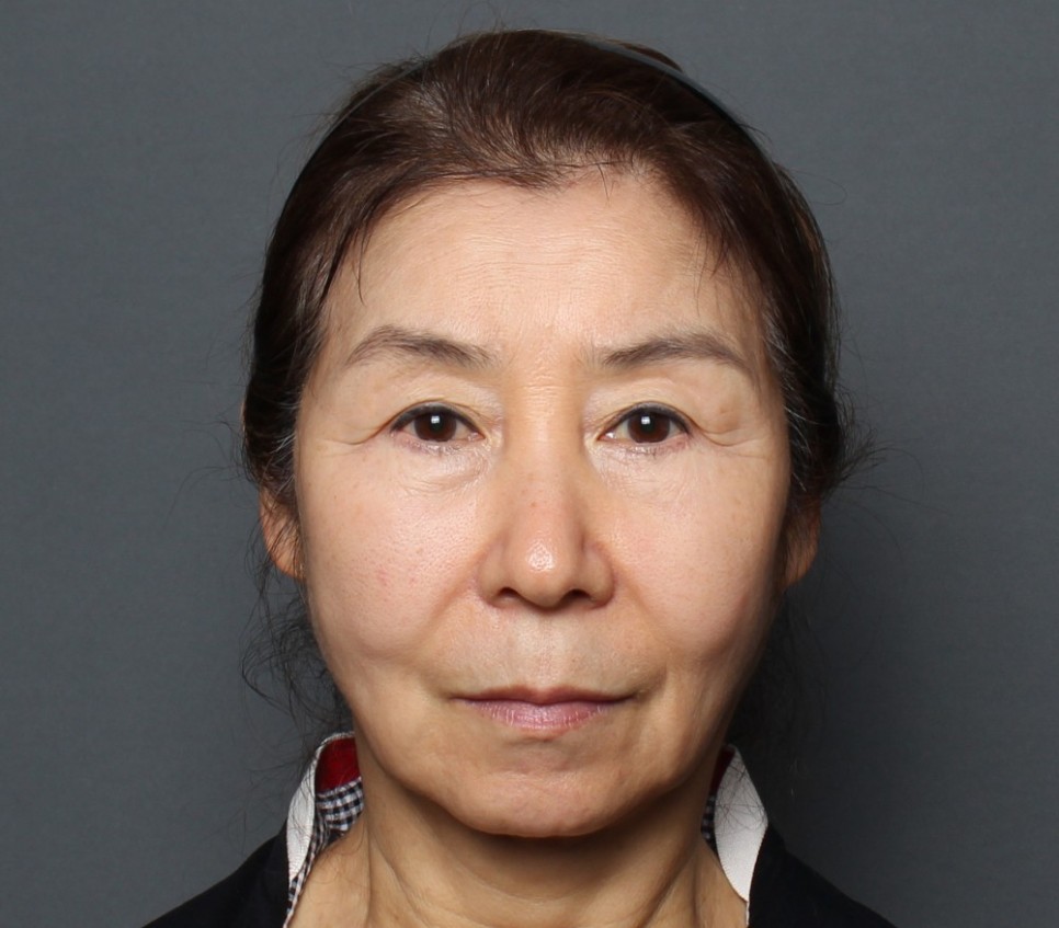 THEPLAN美容整形外科で切開リフトを受けた63歳女性の手術前の正面写真