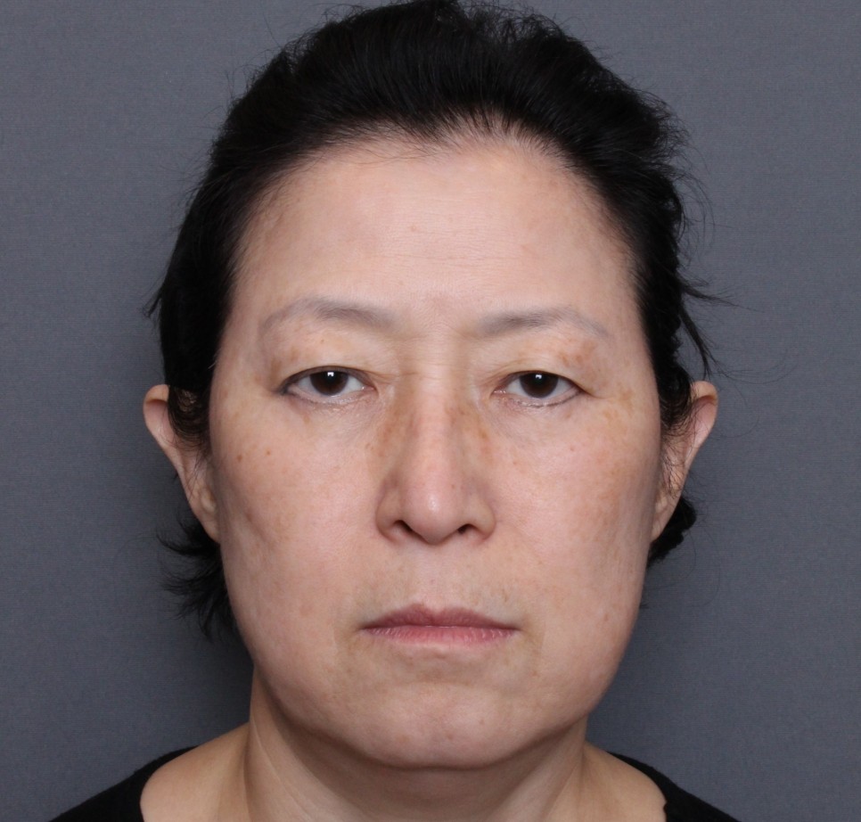 THEPLAN美容整形外科・皮膚科にて切開リフトを行った60代から70代の女性の正面