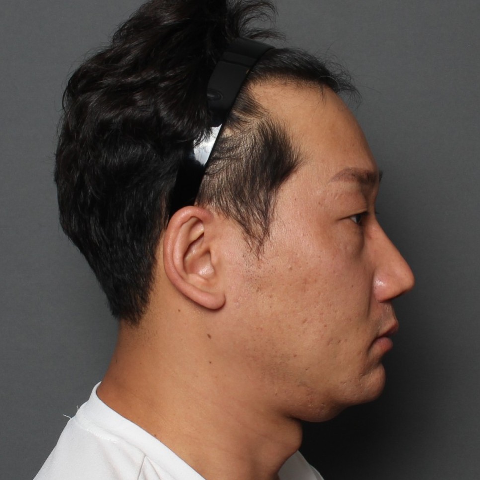 THE PLAN美容整形外科で切開リフトを受けた40代男性の手術前の写真