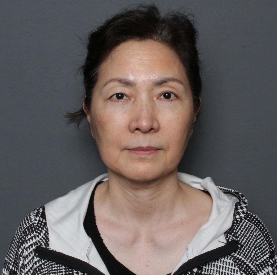 THE PLAN美容整形外科で切開リフトを受けた女性の手術前と手術後の比較写真(正面)