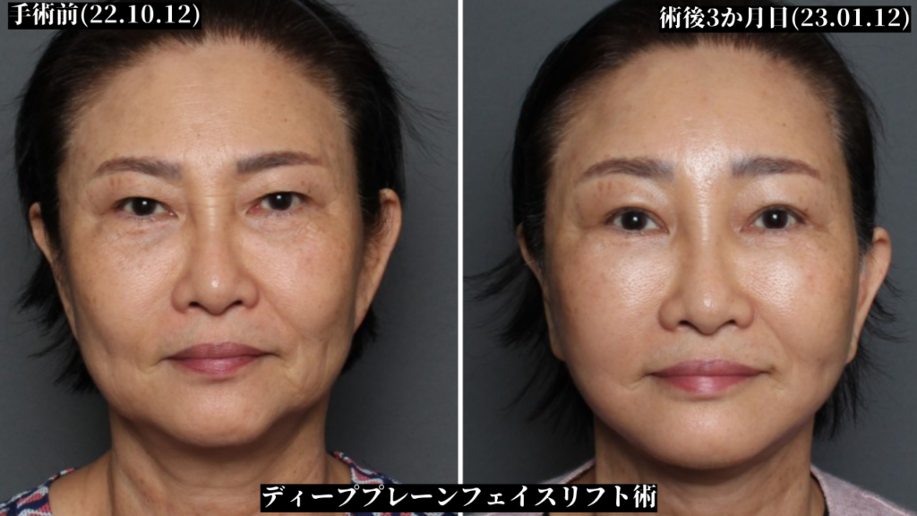 THE PLAN美容整形で切開リフトの再手術を受けた女性の手術前と術後の変化の症例写真