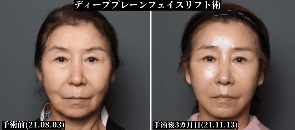 THEPLAN美容整形外科で切開リフトを受けた63歳女性の正面写真