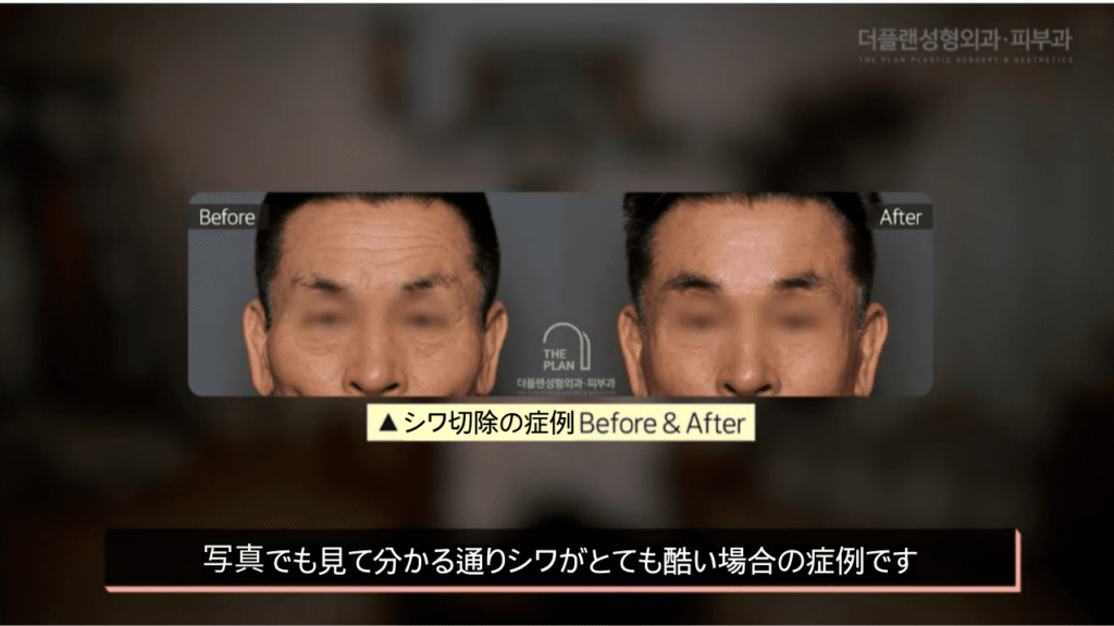 額挙上術について詳しく紹介したブログ内の写真。おでこのシワが改善された男性の症例写真