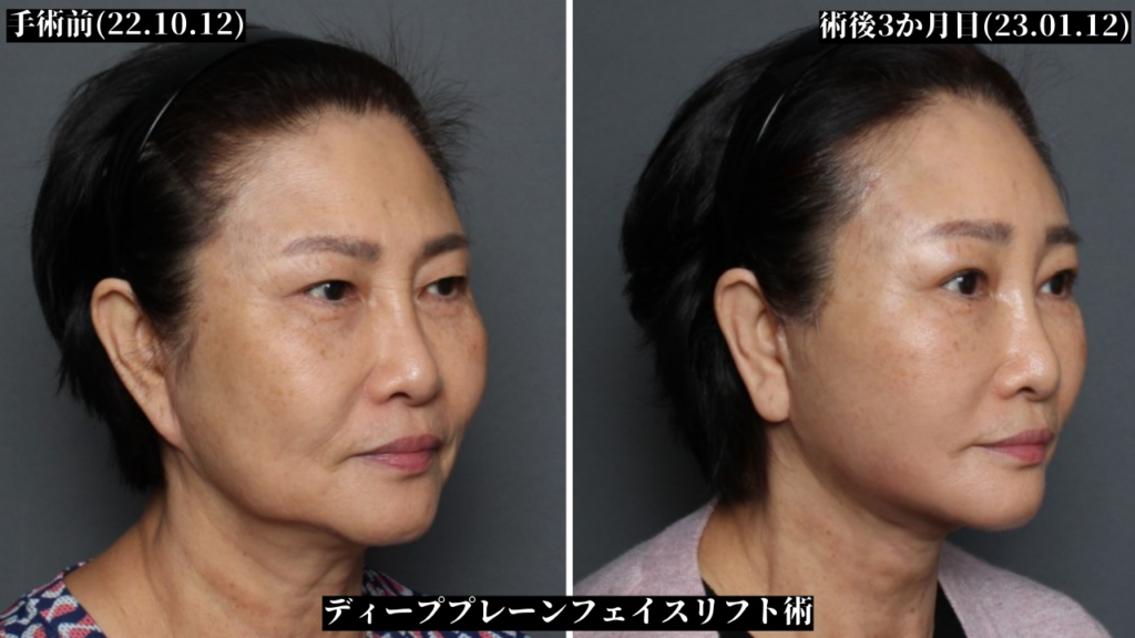 THE PLAN美容整形で切開リフトの再手術を受けた女性の手術前と術後の変化の症例写真