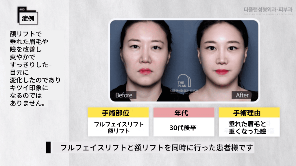 フルフェイスリフトと額リフトを受けた女性の症例