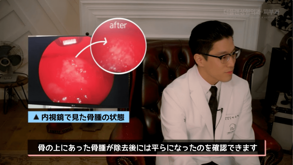 骨腫の除去を説明した写真。術後には膨らんでいる部分が手術で平な状態になっている。