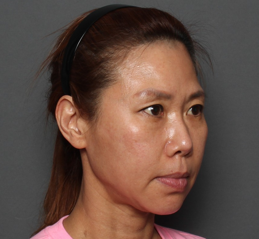 THE PLAN美容整形外科で切開リフトを受けた女性の手術前の写真