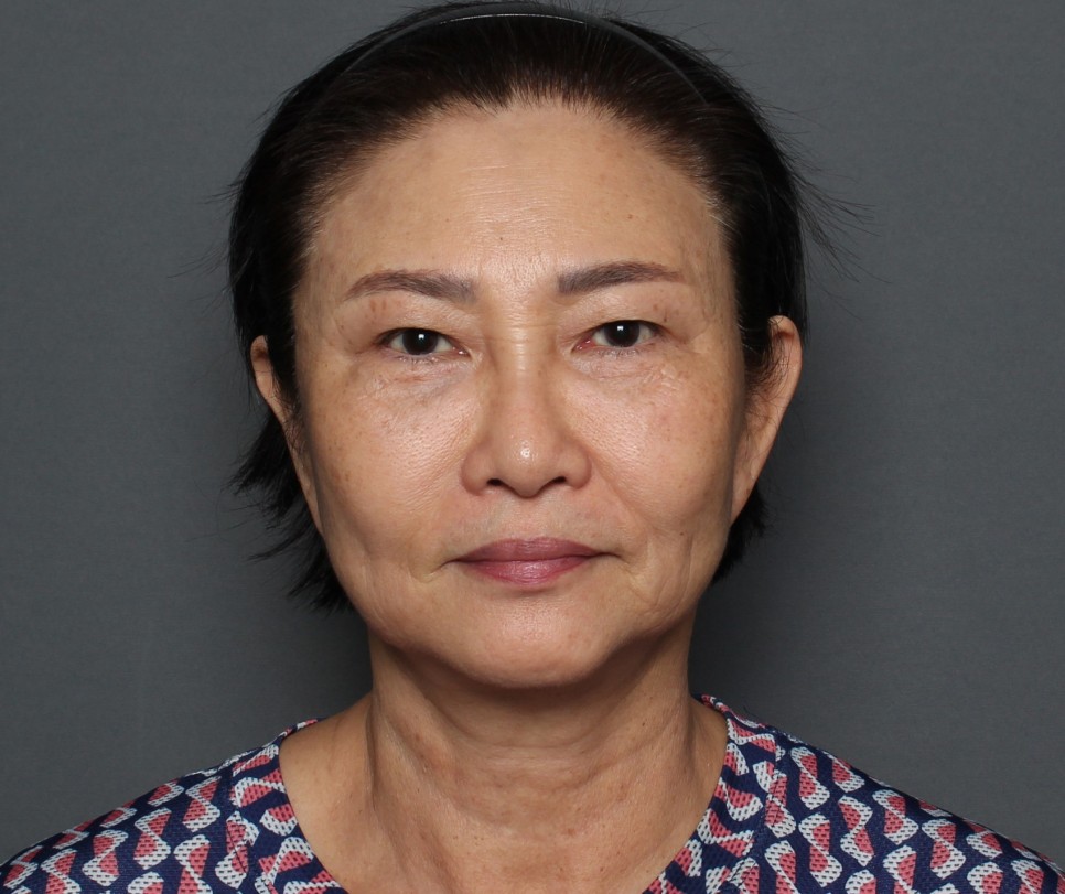 THE PLAN美容整形で切開リフトの再手術を受けた女性の手術前と術後の変化の症例写真