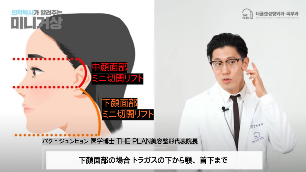 THE PLAN美容整形でのミニ切開リフトについてパク・ジュンヒョン院長が説明している画像