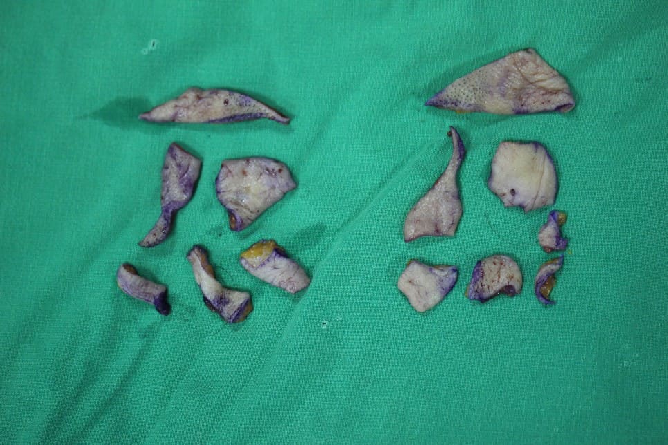 THE PLAN美容整形外科で手術を受けた方の切除した皮膚の写真