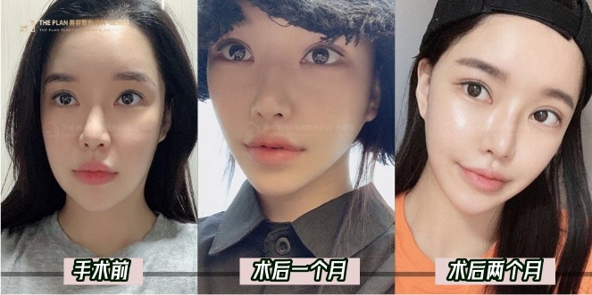 介绍THE PLAN整形外科的“美丽Face计划”
