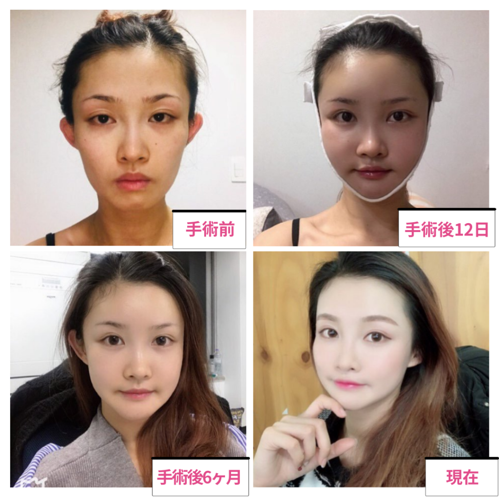 THE PLAN美容整形外科：輪郭3点による術後の劇的な変化