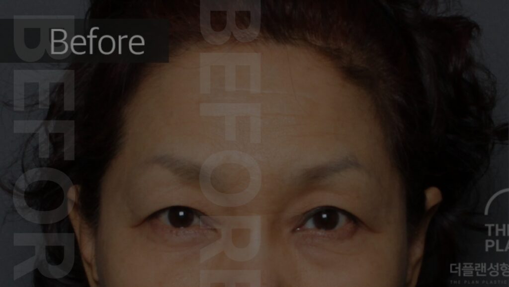 before surgery