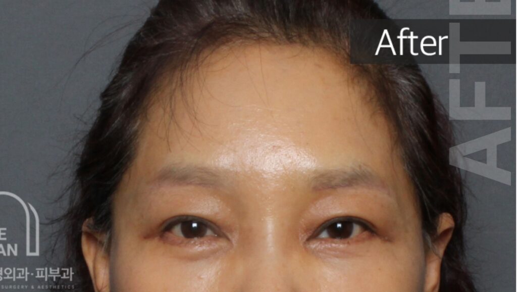 after surgery