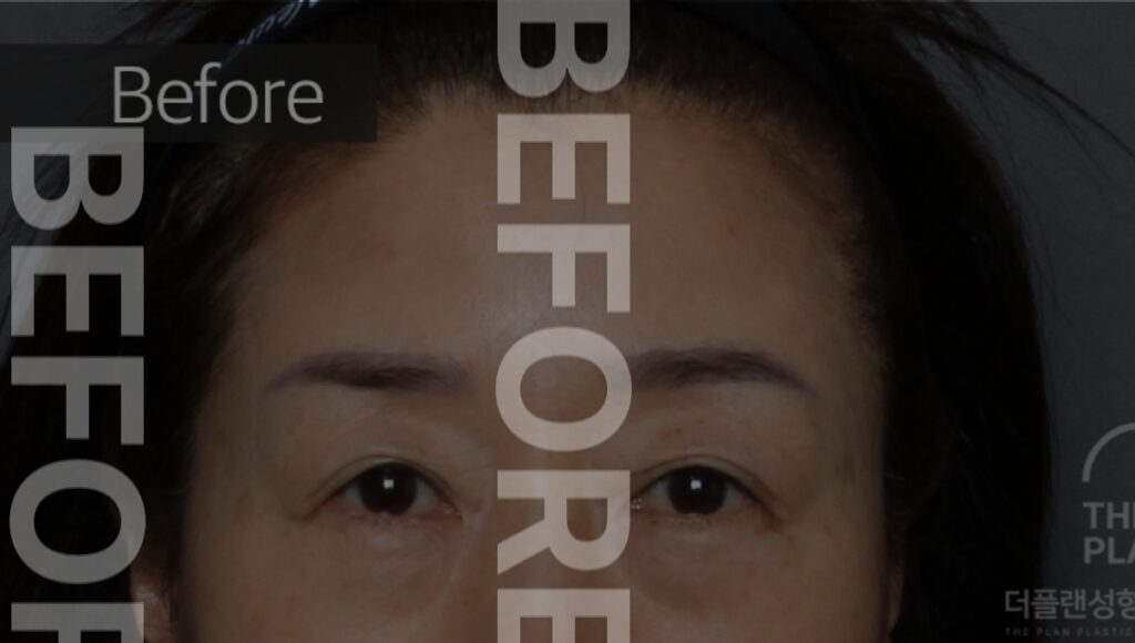 before surgery