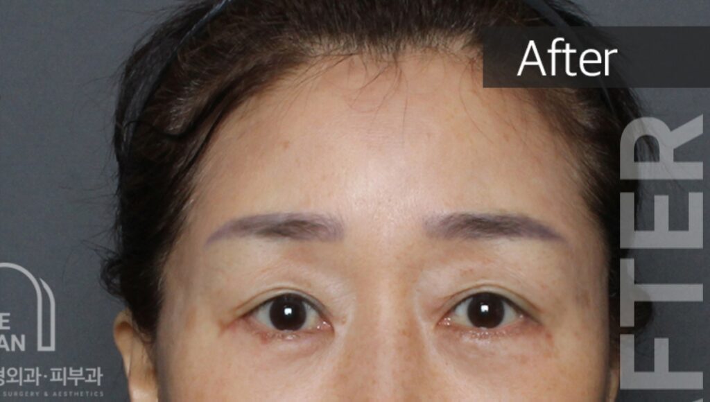 after surgery