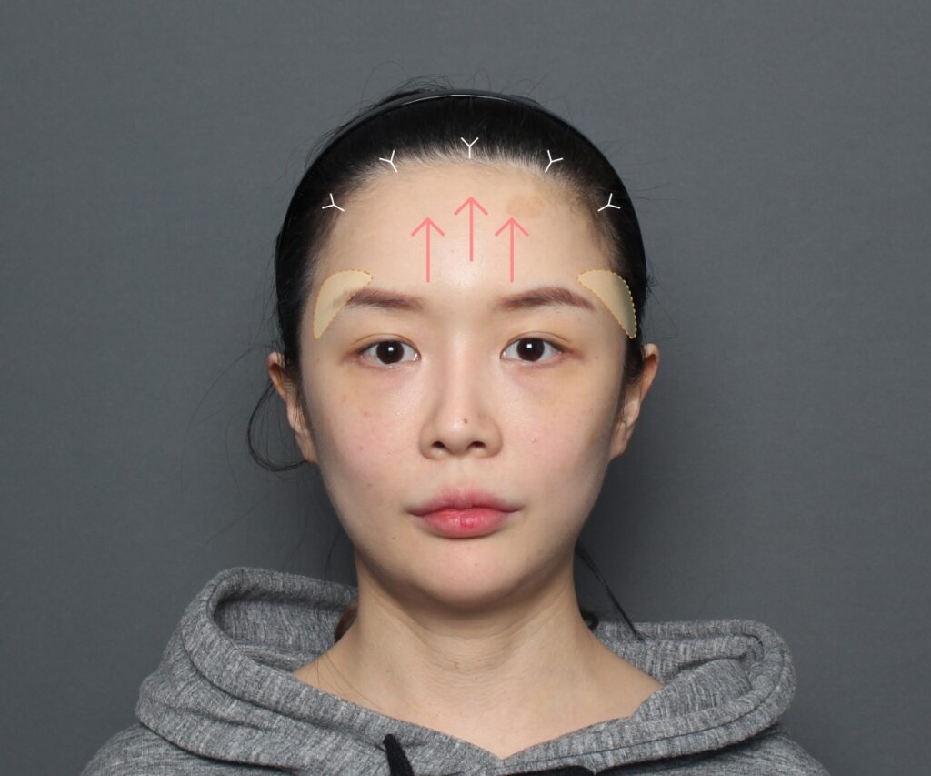 before surgery
