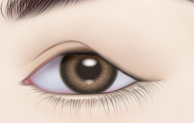 lift and secure the sagging eyelids