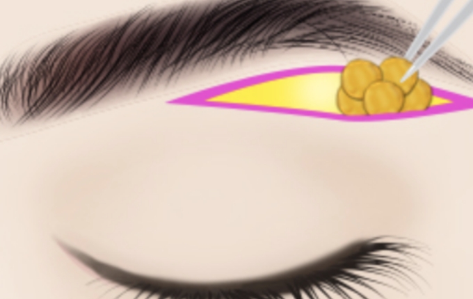 make an incision below the brows