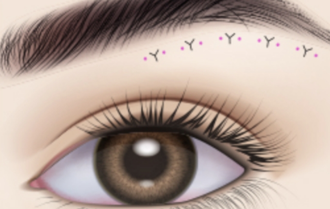 meticulously sutured