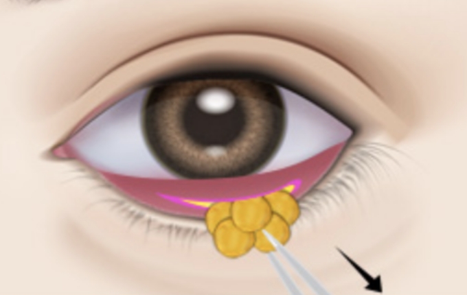 incisions on the inner side to redistribute fat deposits