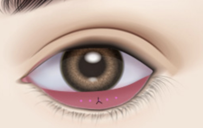 suture the submucous area to ensure no scarring is left